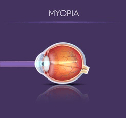Myopia (Nearsightedness) Myopia (Nearsightedness)
