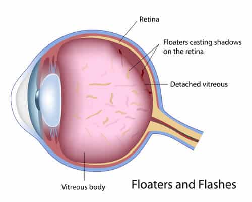 Chart Showing How Flashes and Floaters Affect the Eye