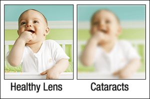 cataracts diagram