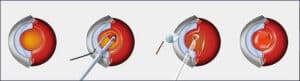 Cataract Surgery Process