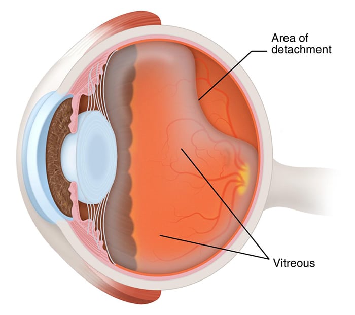 Chart Showing How Detached Vitreous Affects the Eye