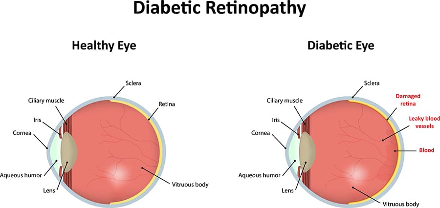 Diabetic Retinopathy