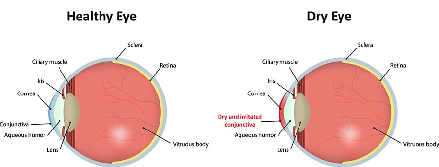 Chart Showing a Healthy Eye Compared to One Experiencing Dry Eye