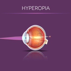 Hyperopia