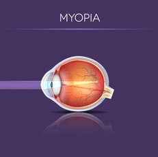 Myopia