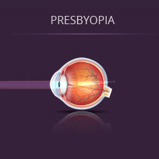 Presbyopia