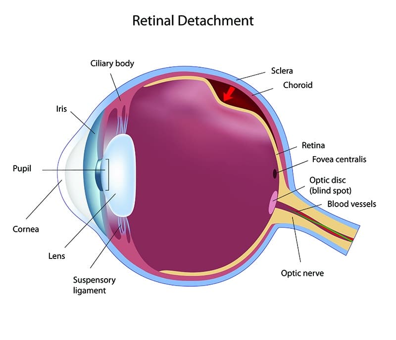 Chart Showing How Retinal Detachment Affects the Eye