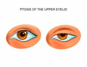 Ptosis of the upper eyelid