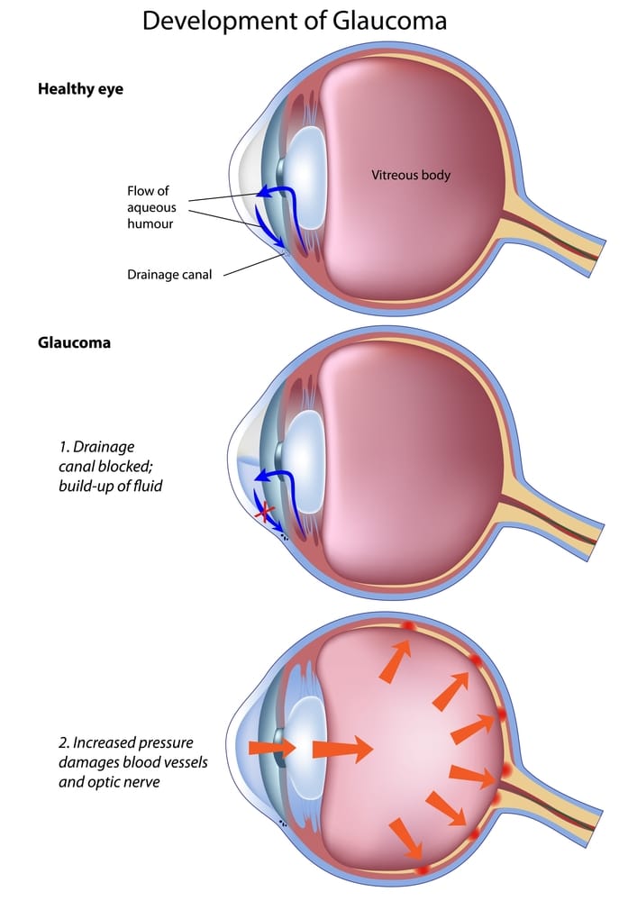 glaucoma diagram 